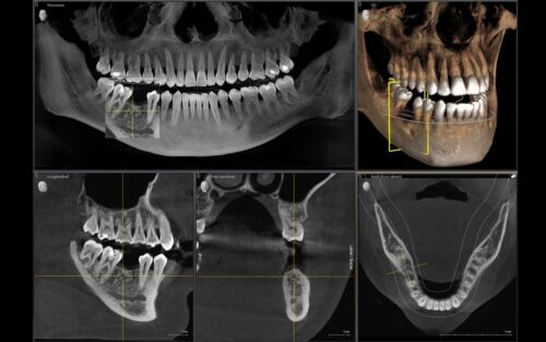 tecnología 3D en Valencia-Clínica dental Cots