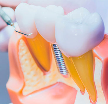 Mantenimiento de los implantes dentales